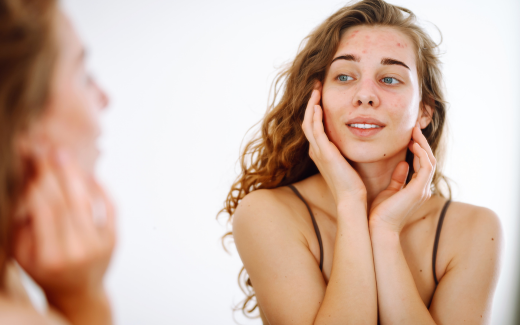 Rougeurs et acné après l’été : Comment éviter l'effet rebond sur votre peau ?